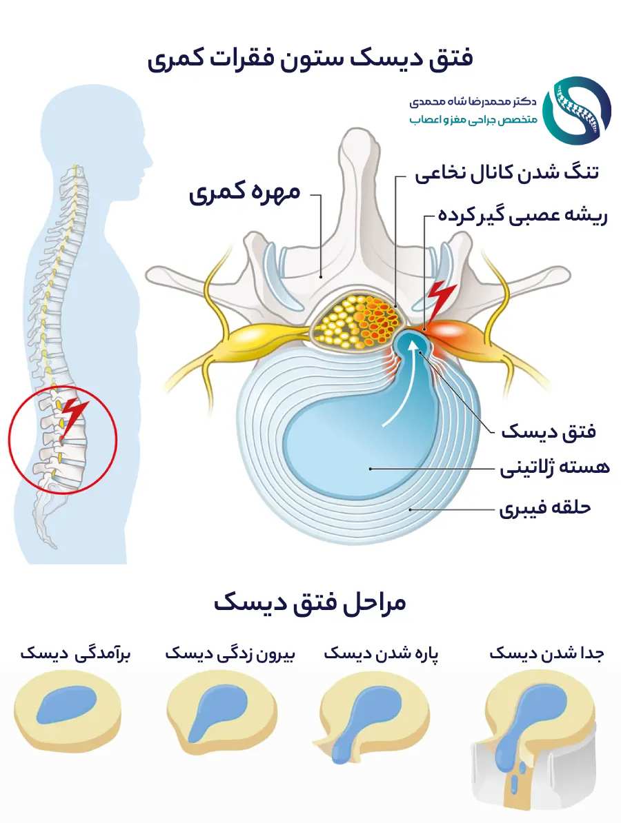 lcfxujbntcbeu26jt0ef8gb3rk1hmxwwfecaiq8y دیسک کمر و عکس مراحل فتق دیسک کمر دکتر شاه محمدی