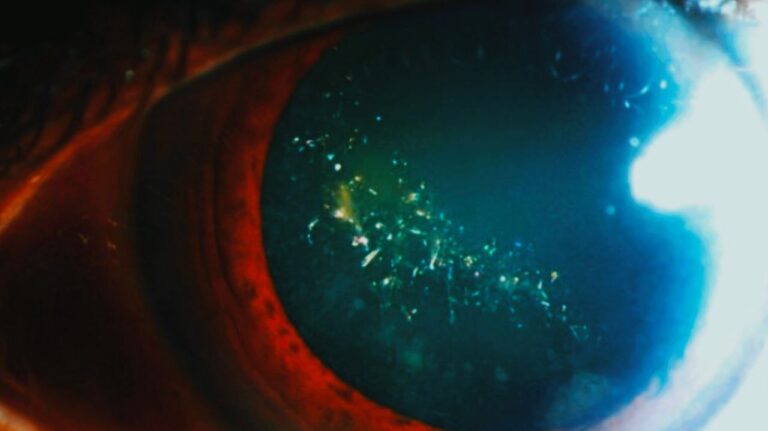 بیماری نادری که چشم‌ها را مانند درخت کریسمس درخشان می‌کند